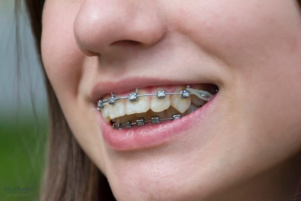 Close-up of a smiling patient showing metal braces on teeth – braces for overbite in New Braunfels, TX.